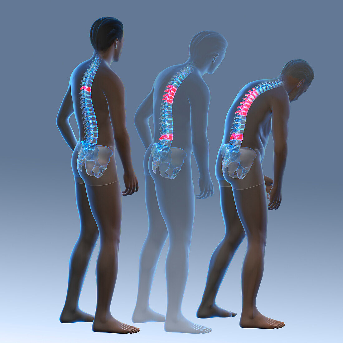 Osteoporosis, illustration