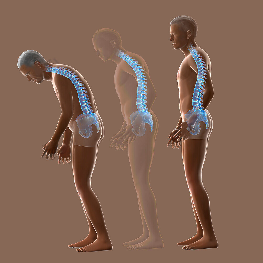 Osteoporosis, illustration