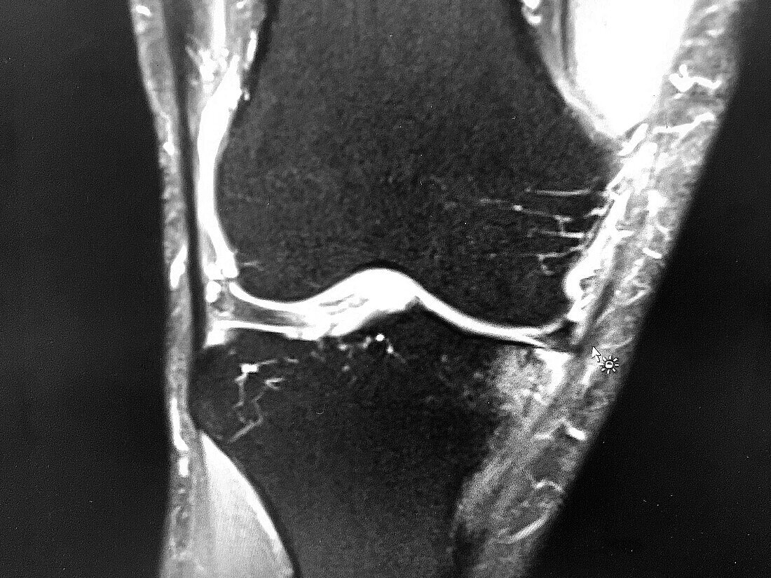 Knee joint with arthritis, MRI scan