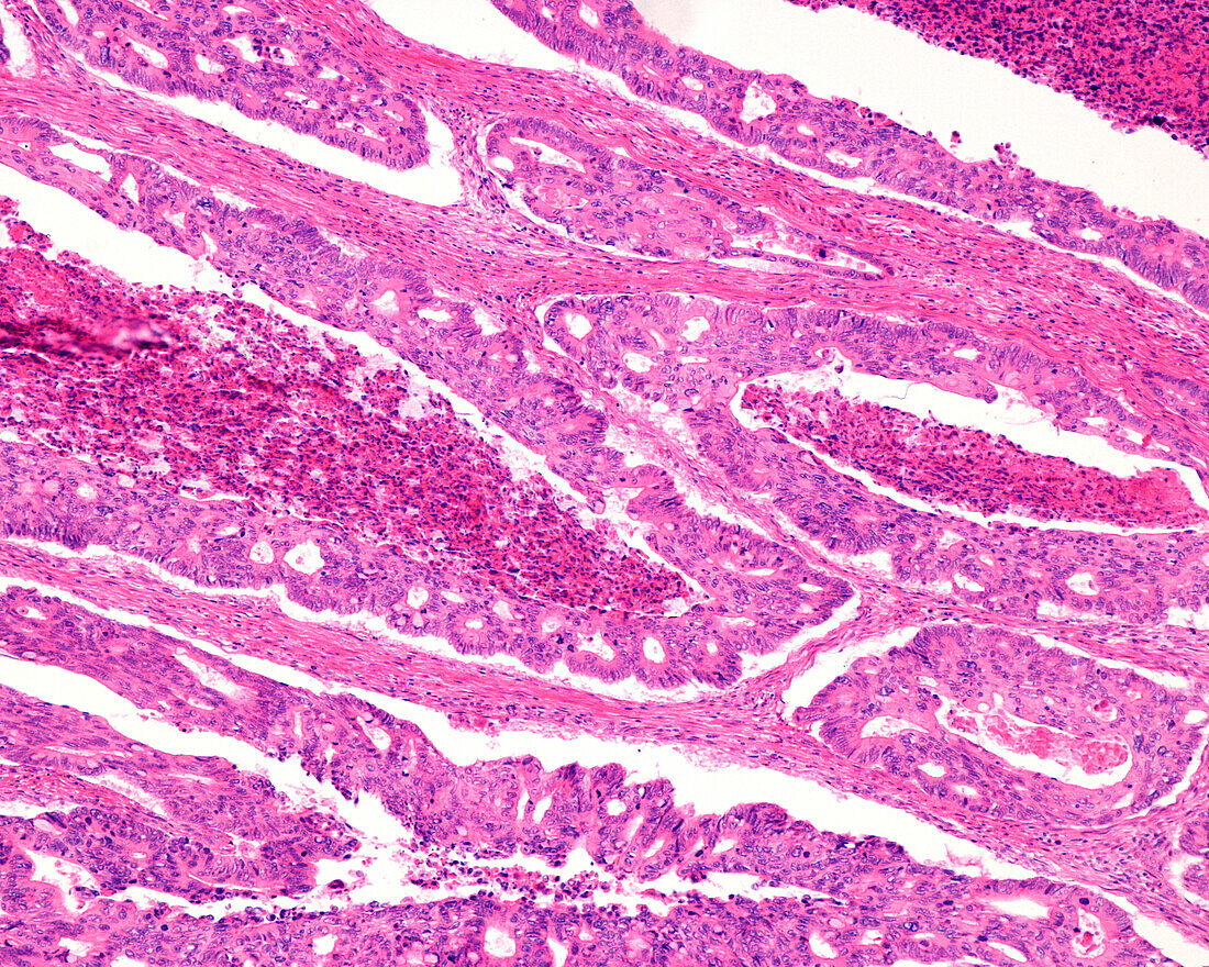 Adenocarcinoma in human colon, light micrograph