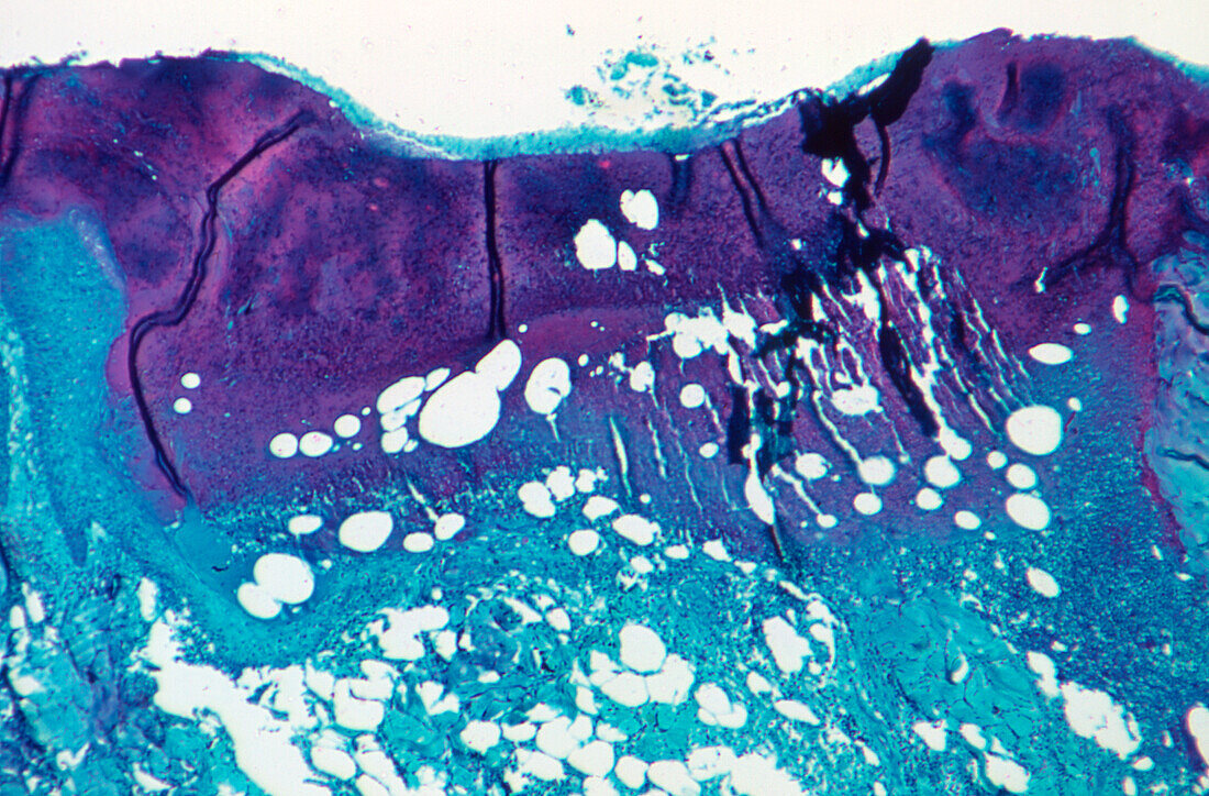 Monkeypox lesion, light micrograph