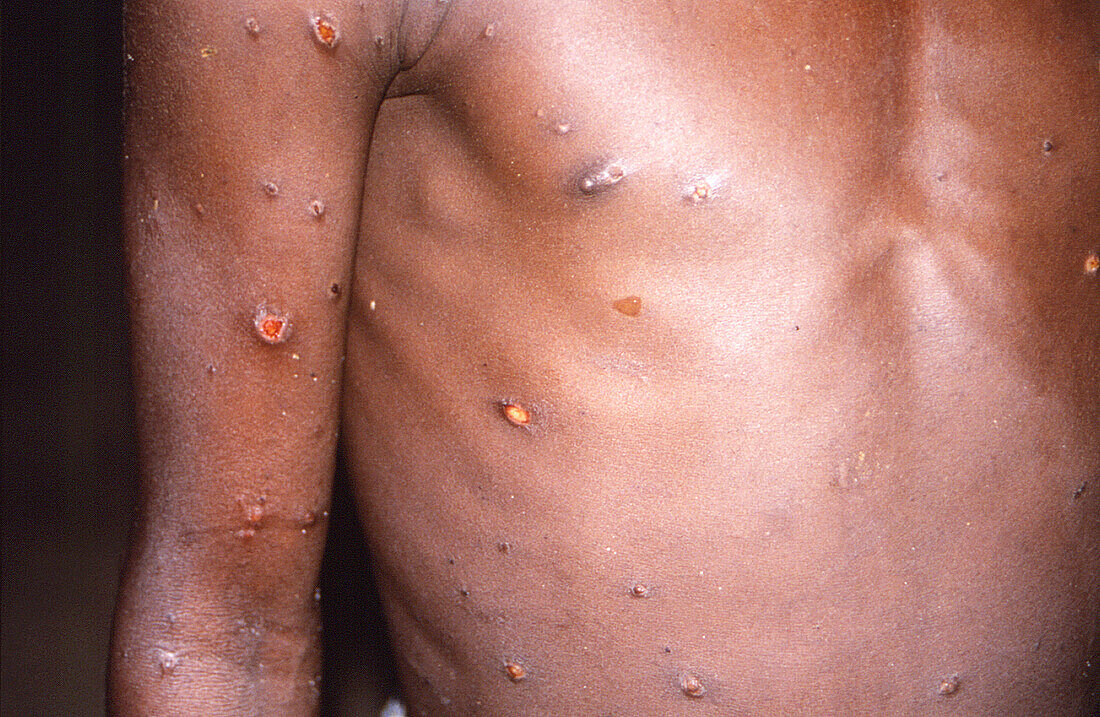 Monkeypox infection