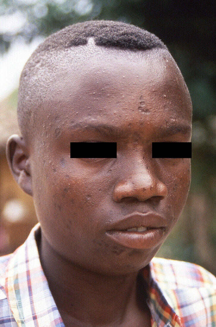 Monkeypox scars