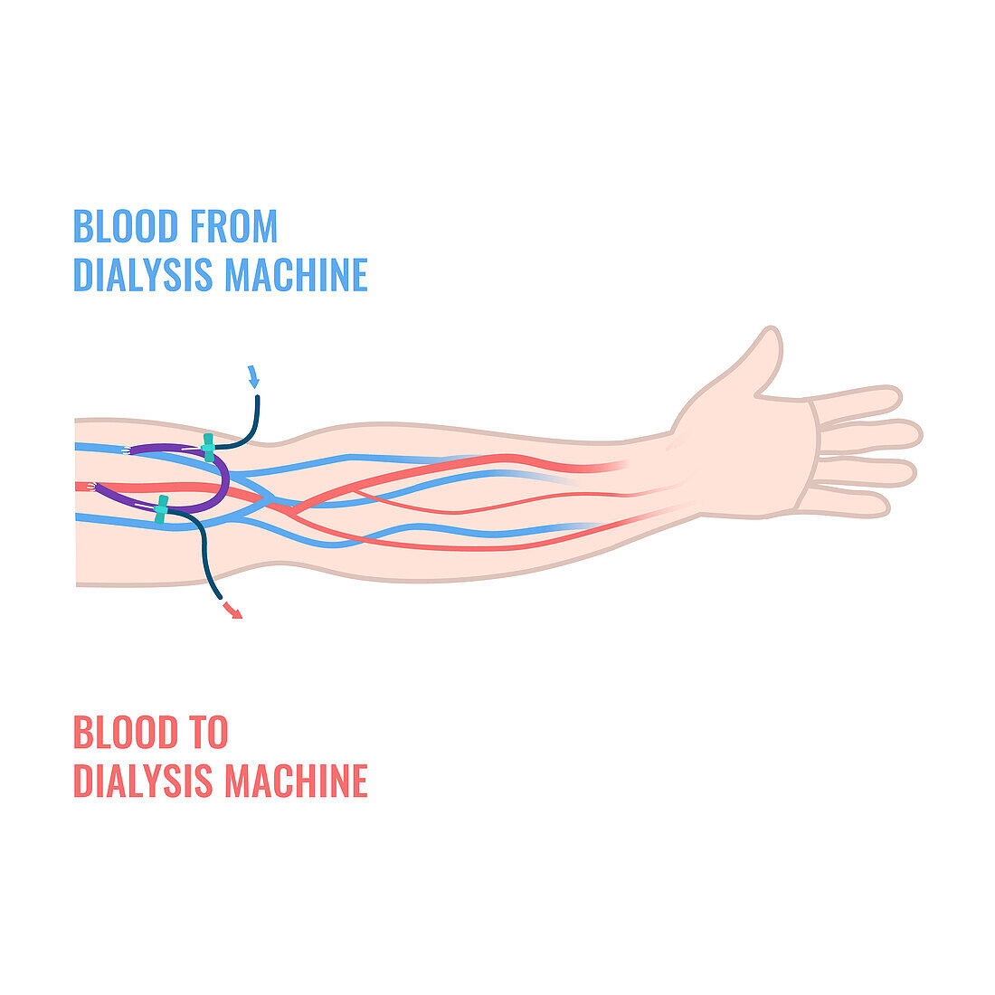 Dialysis shunt graft catheter, illustration