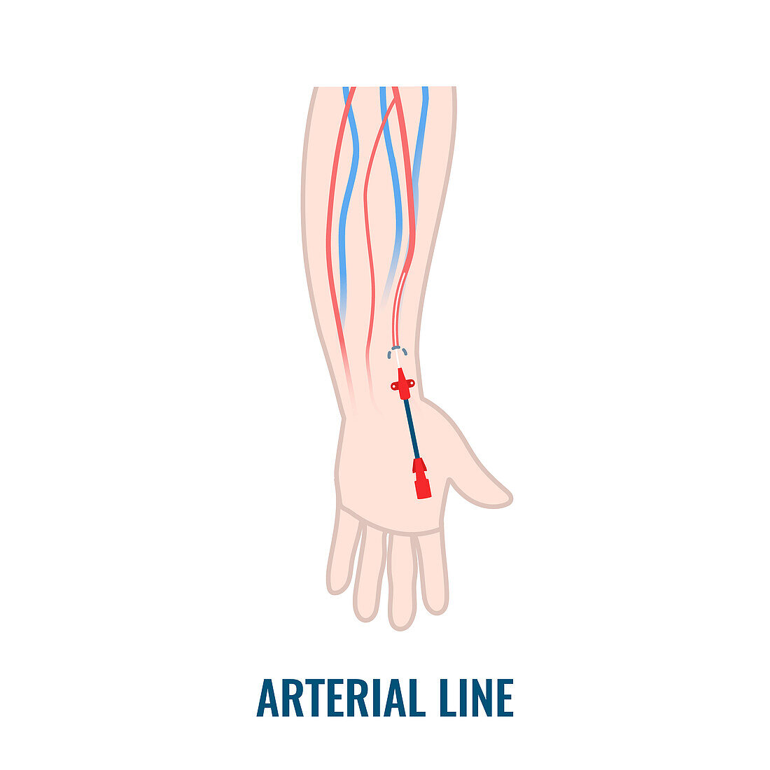 Arterial line catheter, illustration