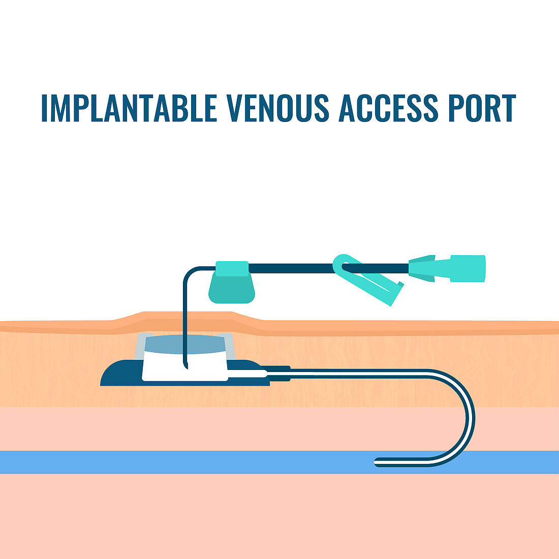 Venous access port, illustration