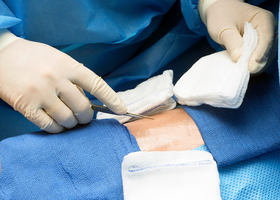 Surgeon preparing to make an incision