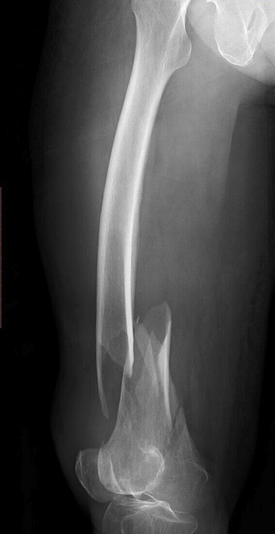 Comminuted femur fracture, X-ray