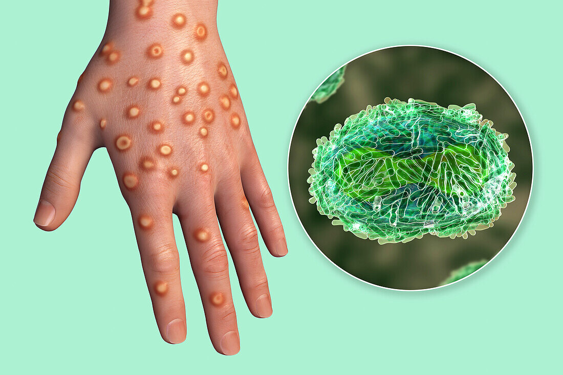 Monkeypox infection, illustration