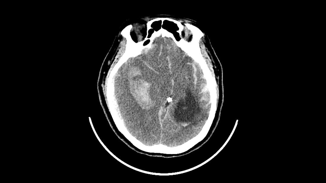Haemorrhagic stroke, CT scan