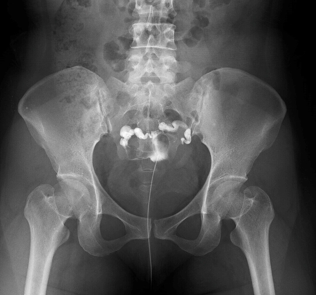 Obstructed fallopian tube, X-ray