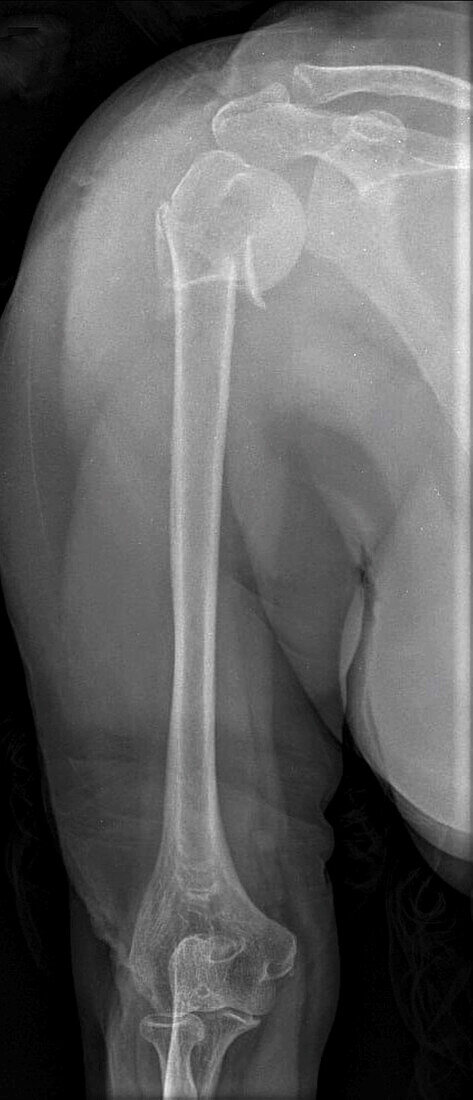 Humerus fracture, X-ray