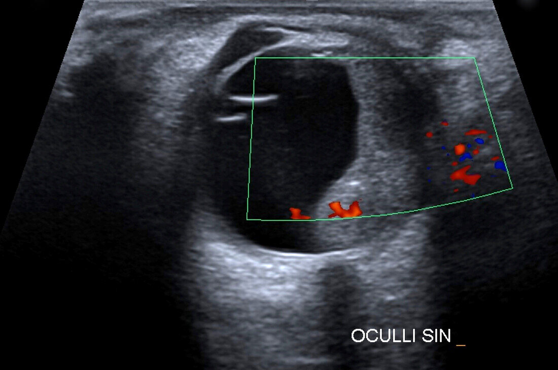 Orbital metastasis, ocular ultrasound scan