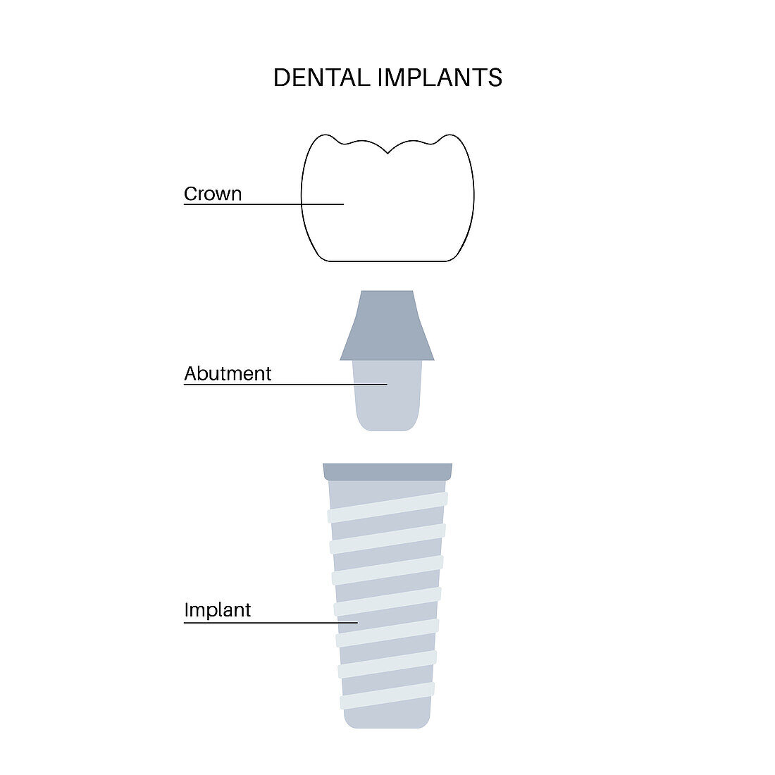 Dental implant, illustration