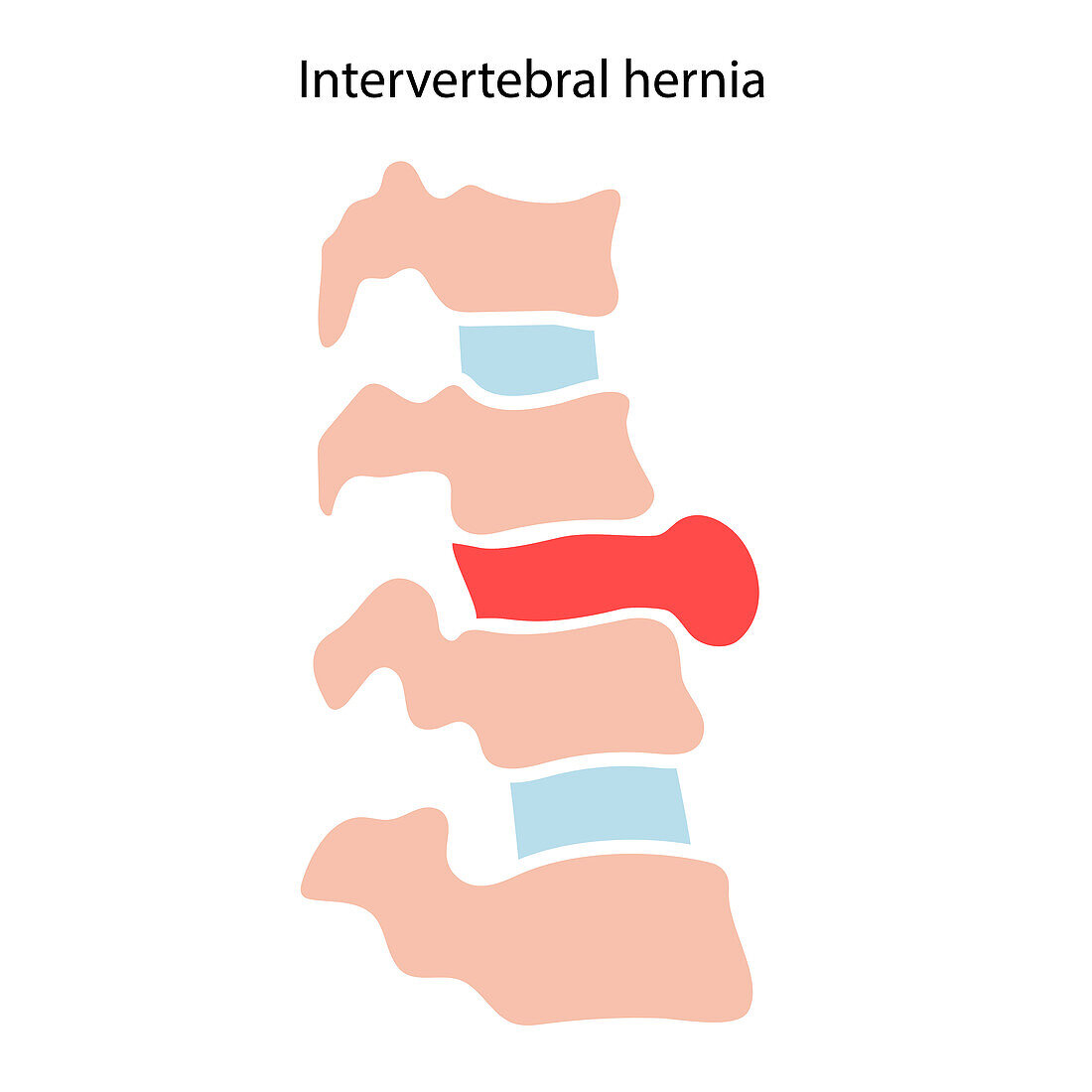 Intervertebral hernia, illustration