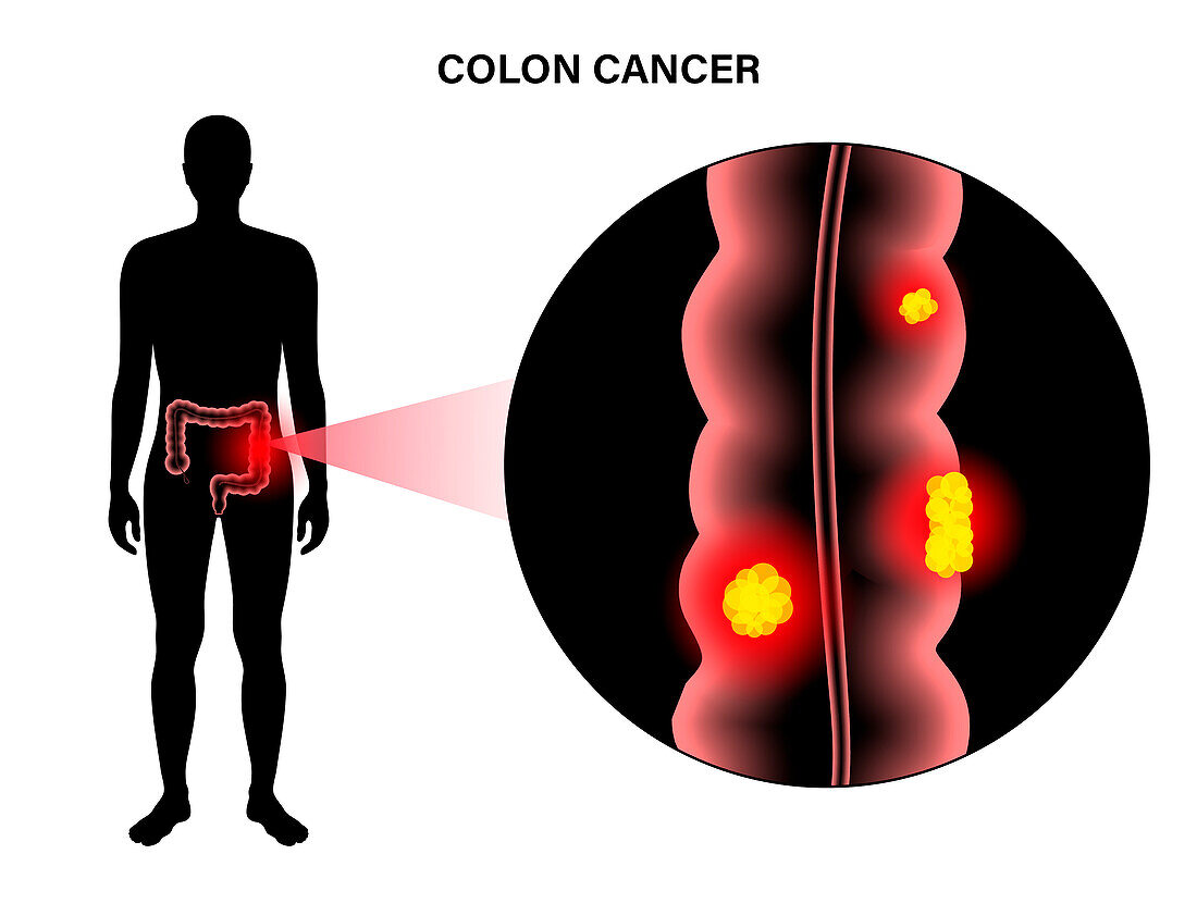 Intestinal cancer, illustration