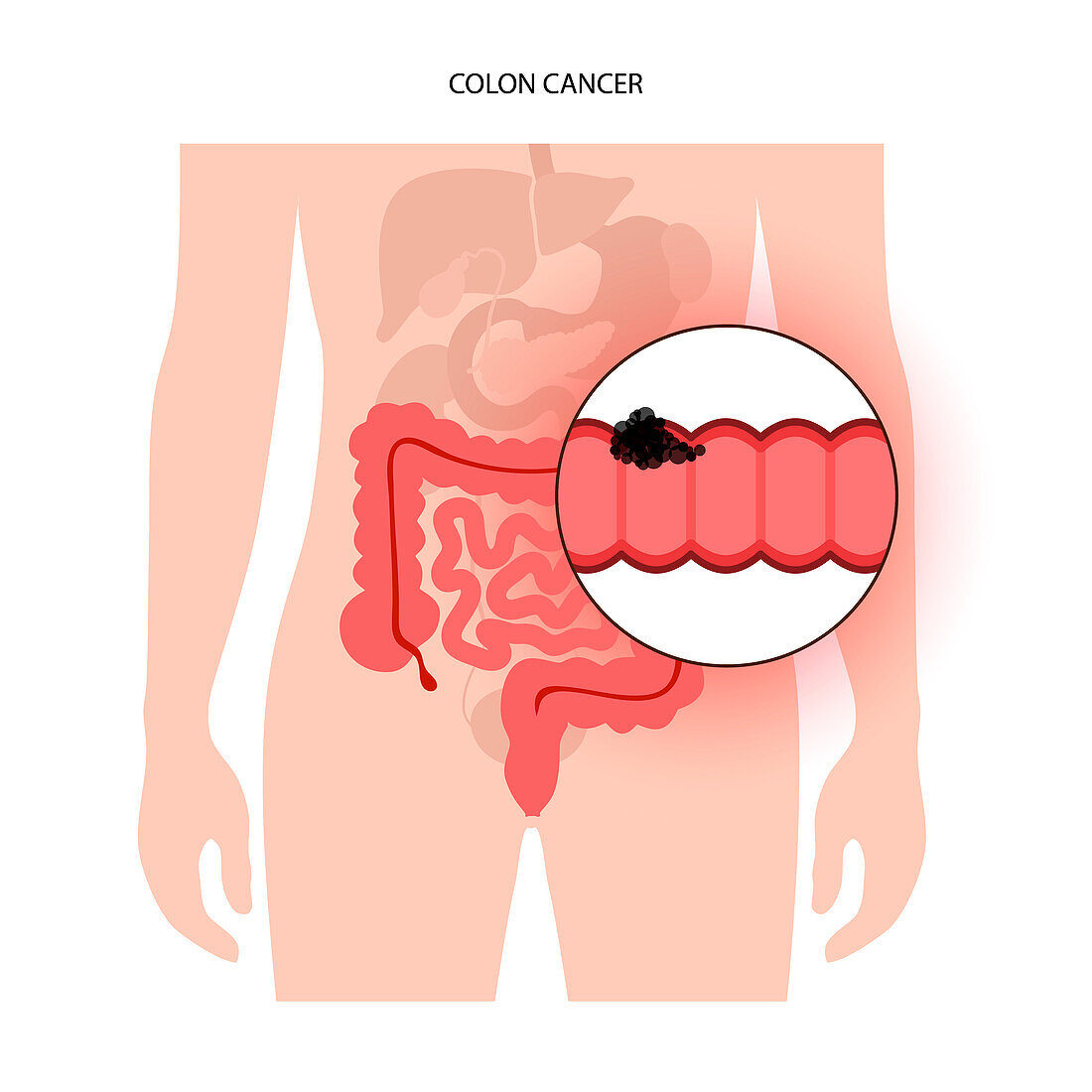 Colon cancer stages, illustration