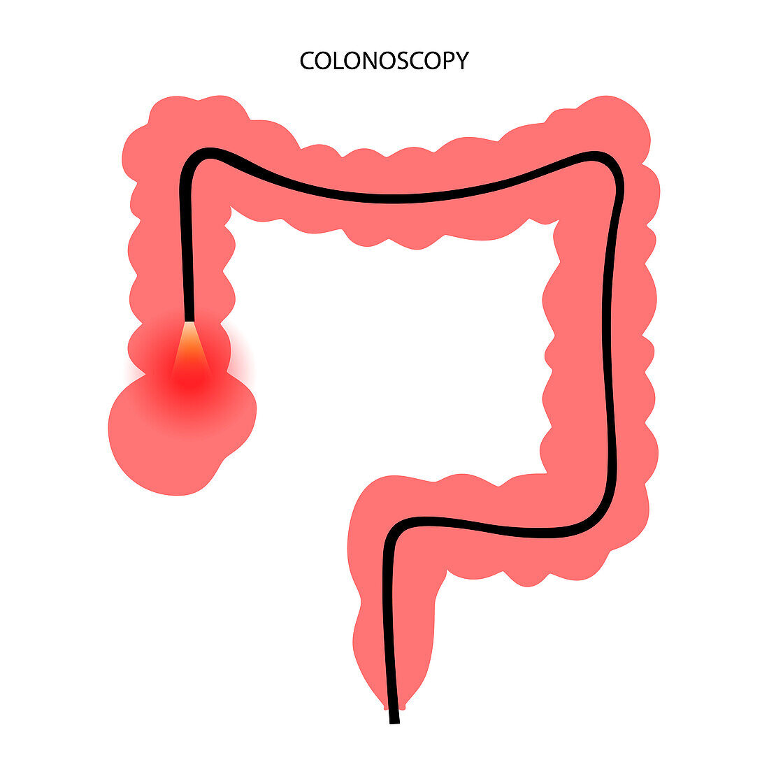 Colonoscopy, illustration