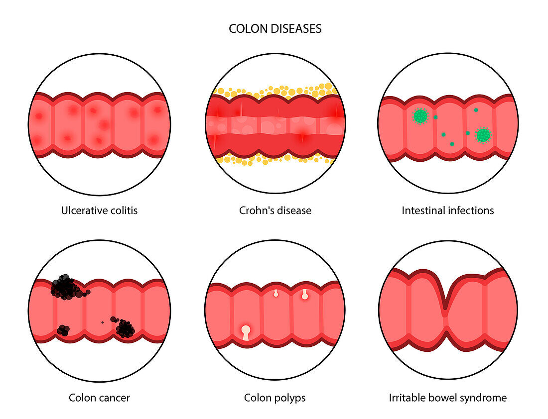 Intestinal diseases, illustration