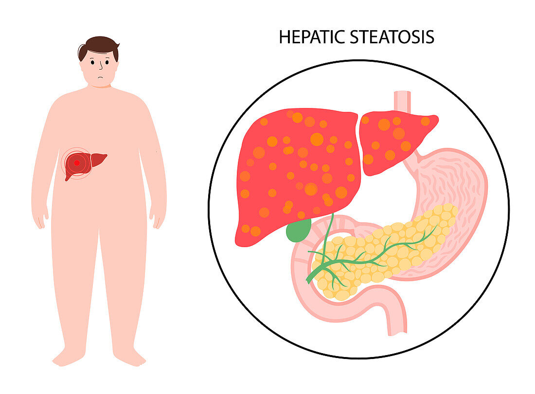 Liver disease, illustration