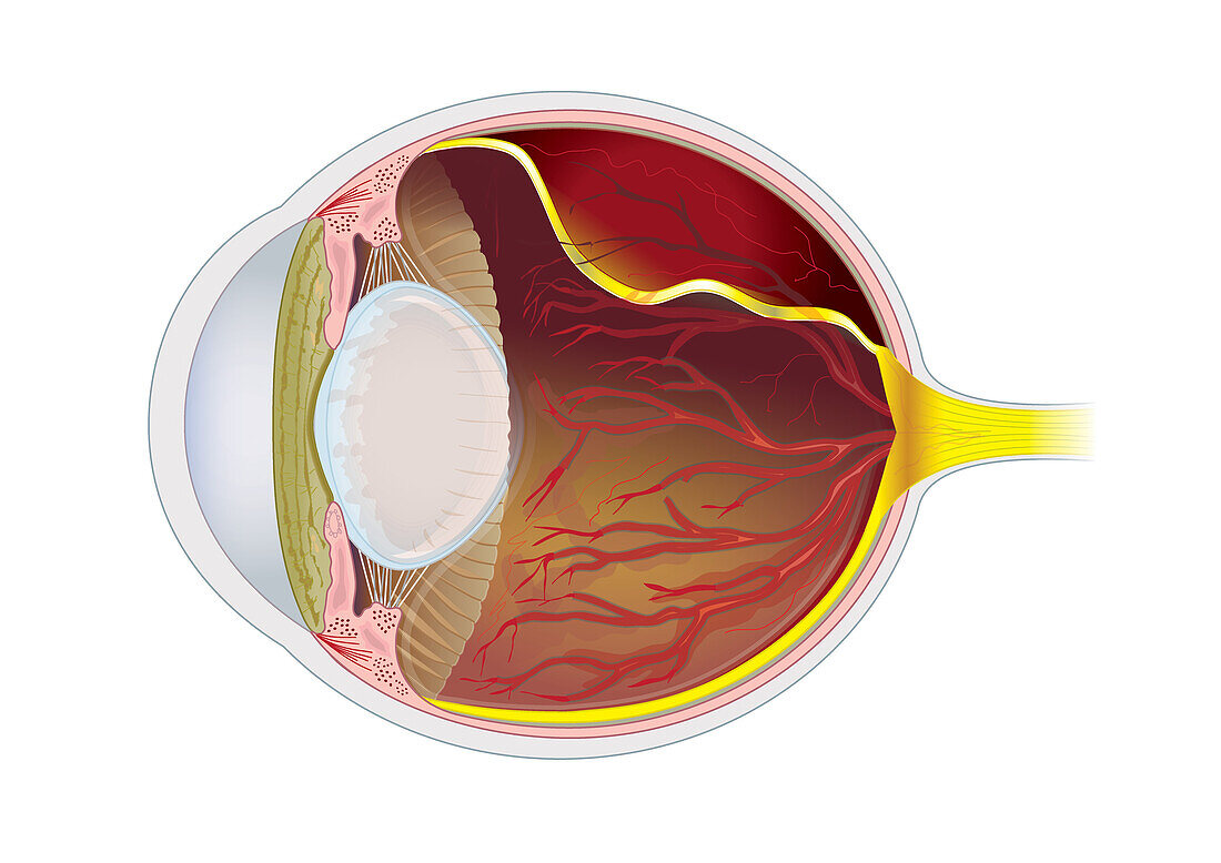 Cat eye with hypertension, illustration