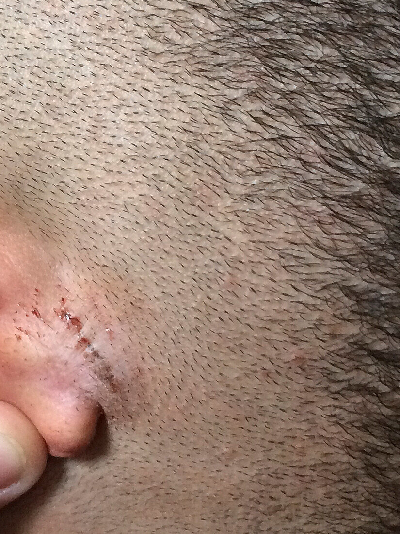 Scar on a teenage boy's ear