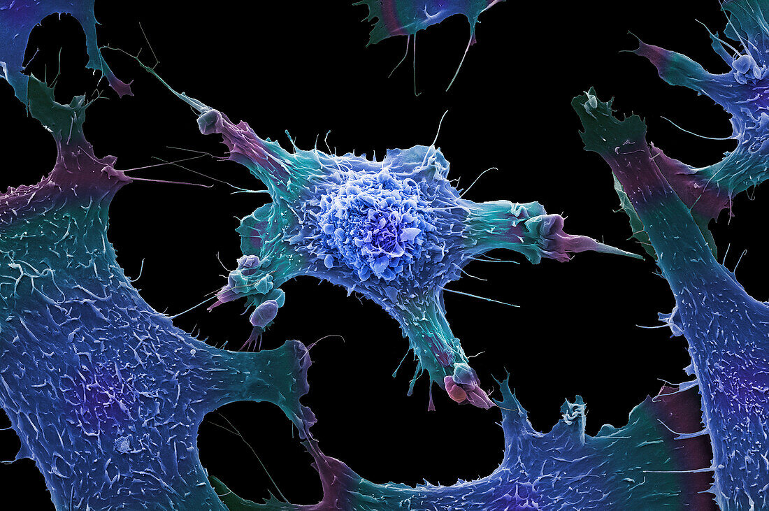 Breast cancer cells, SEM