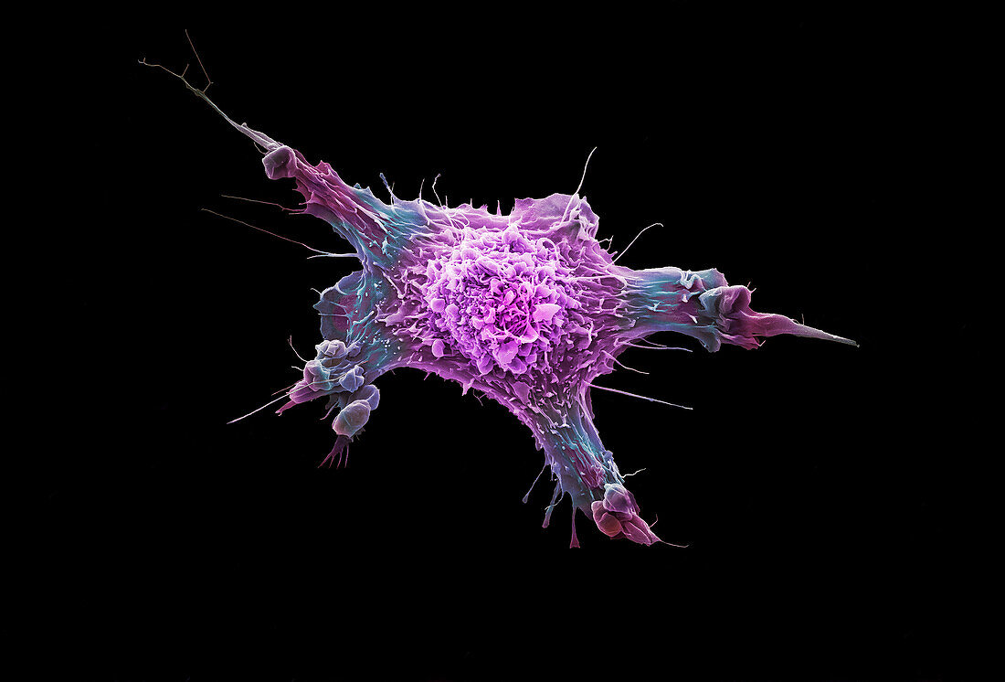 Breast cancer cell, SEM