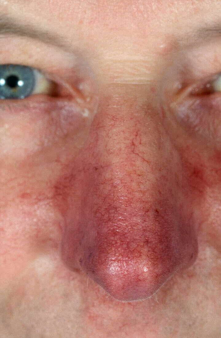Severe rosacea on nose