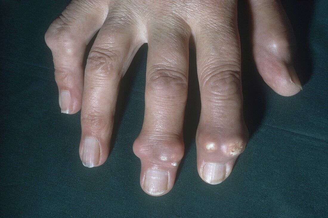 Skin gout