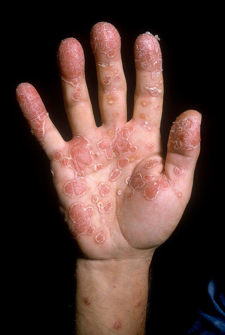 Psoriasis of the palm