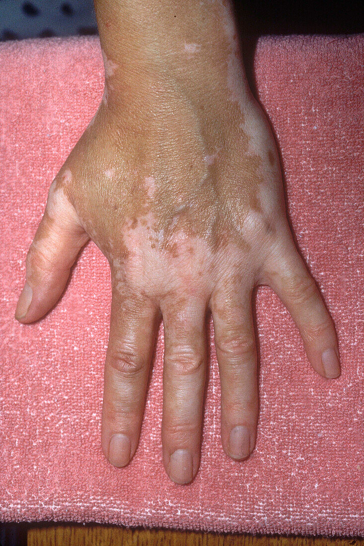 Vitiligo on hands