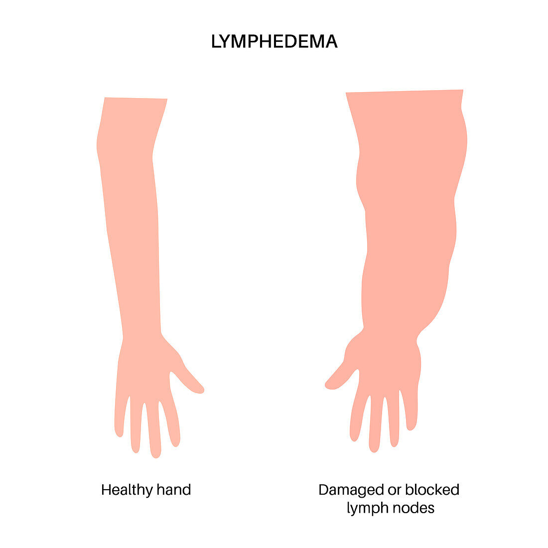 Lymphoedema of arm, illustration