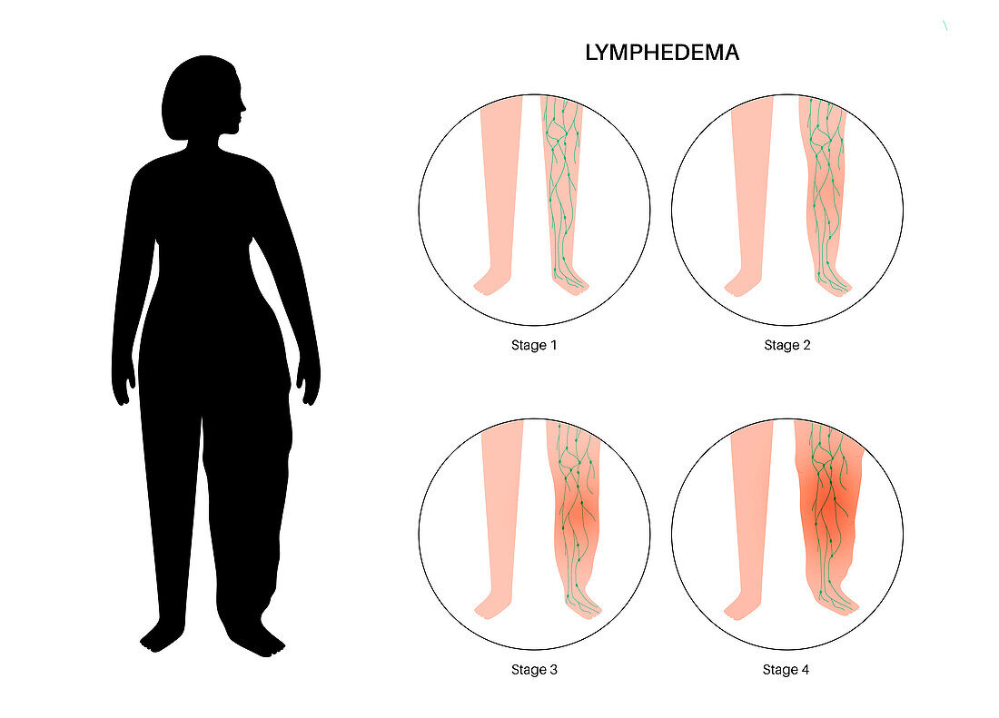 Stages of lymphoedema, illustration