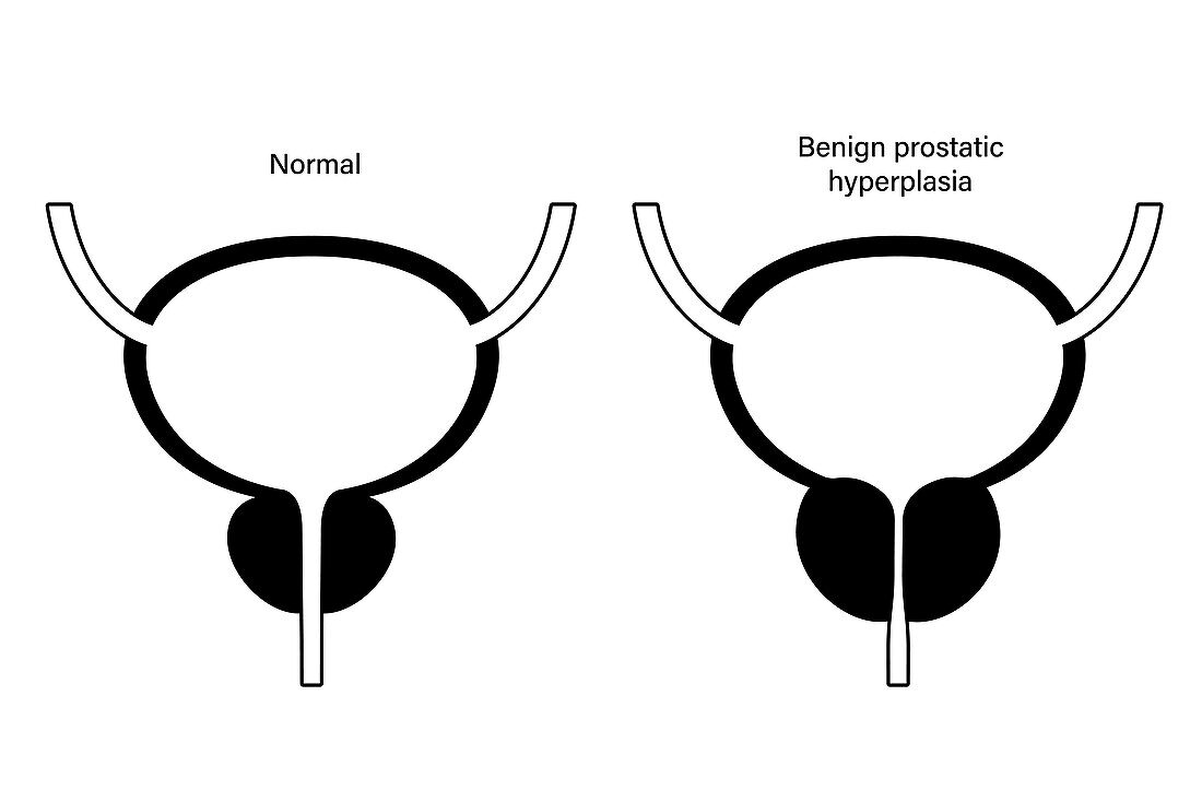 Benign prostatic hyperplasia, illustration