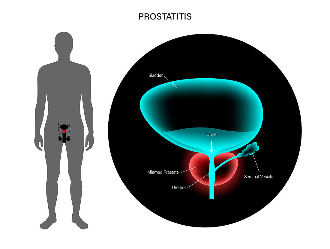 Prostatitis, illustration