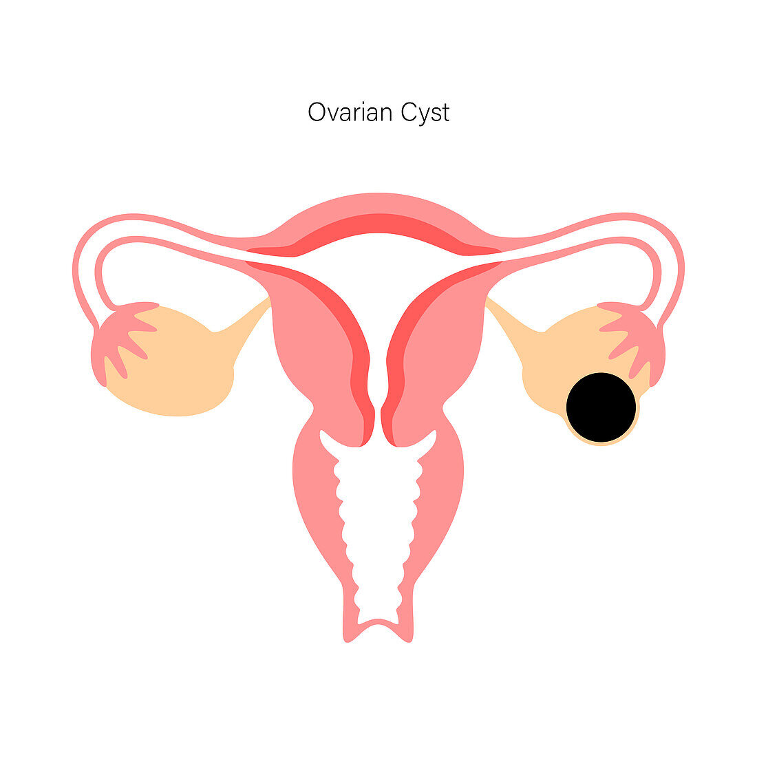 Ovarian cyst, illustration