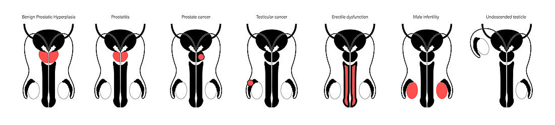 Male reproductive organ diseases, illustration