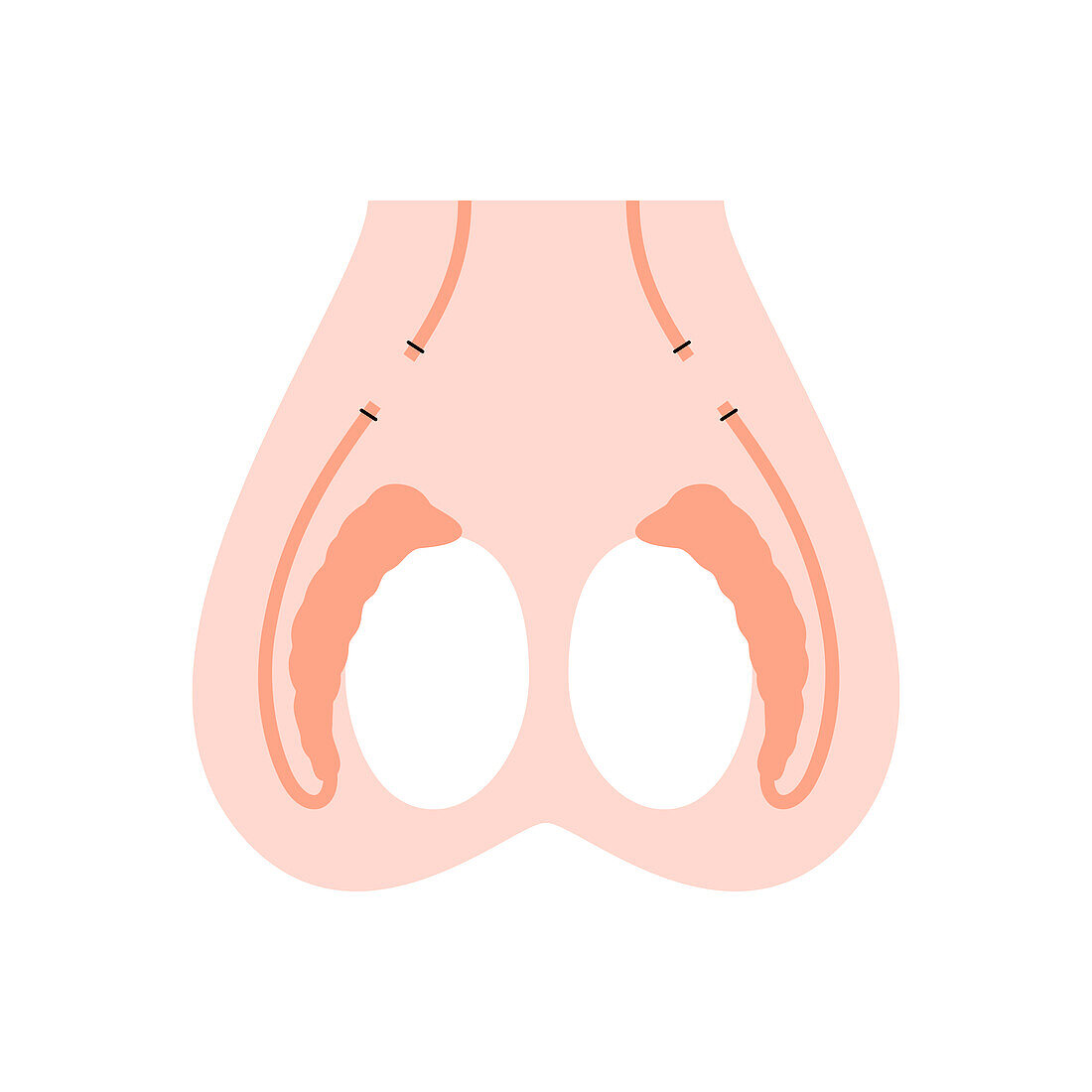 Vasectomy, illustration