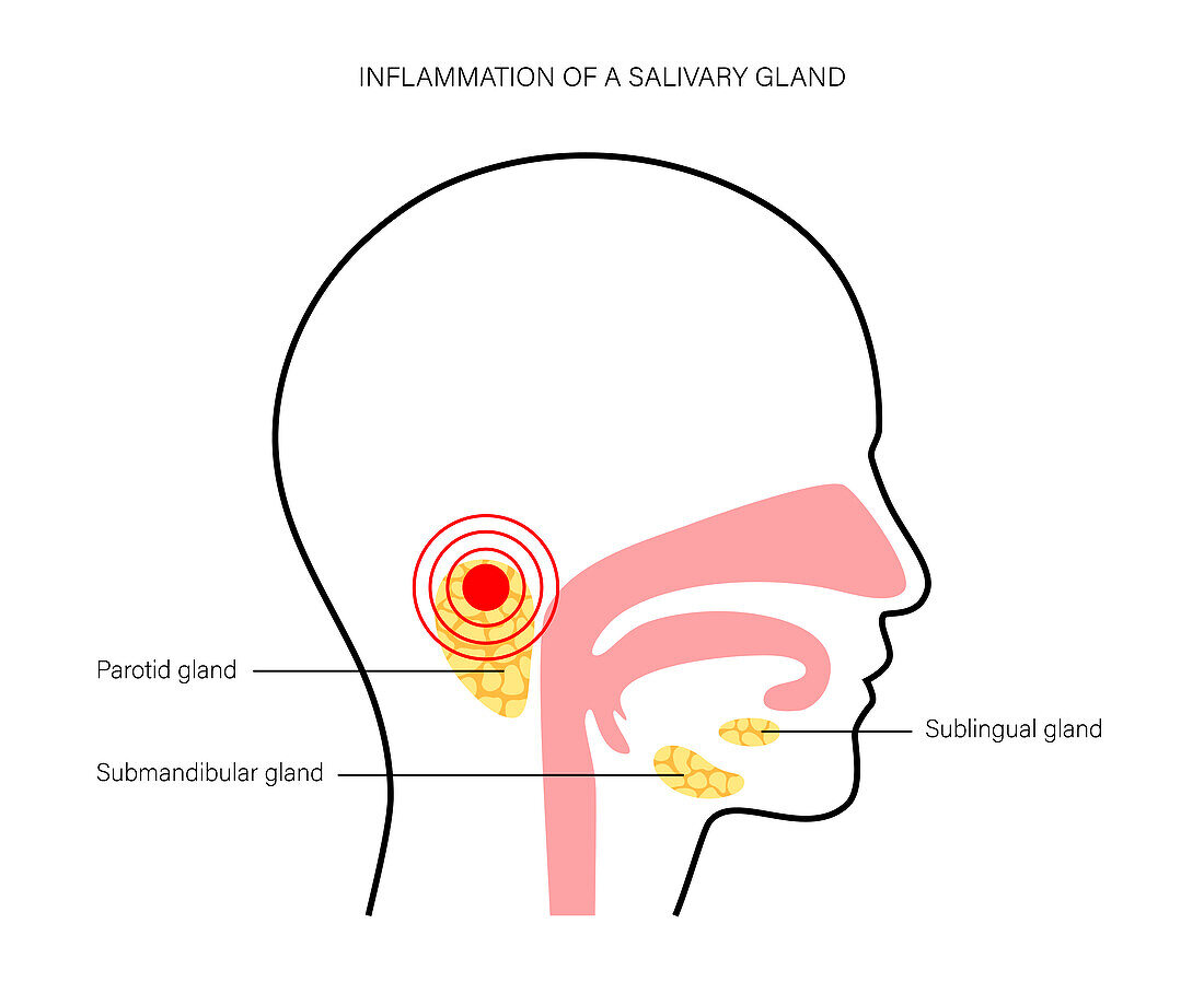 Salivary gland inflammation, illustration