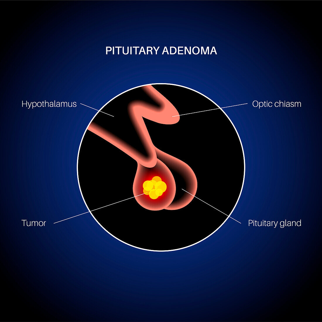 Pituitary adenoma cancer, illustration