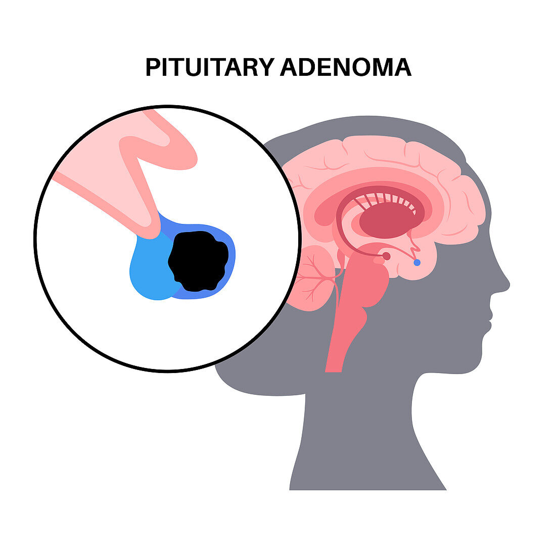 Pituitary adenoma cancer, illustration