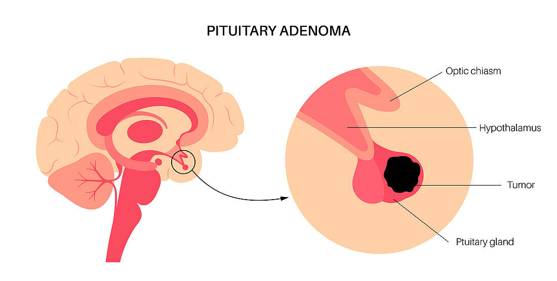 Pituitary adenoma cancer, illustration