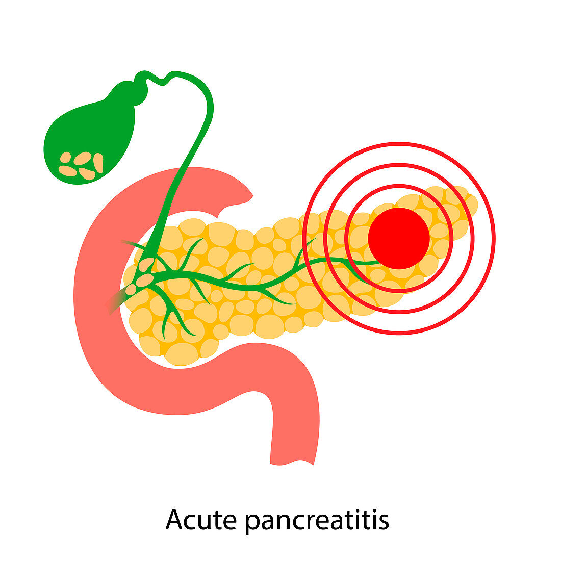 Acute pancreatitis, illustration