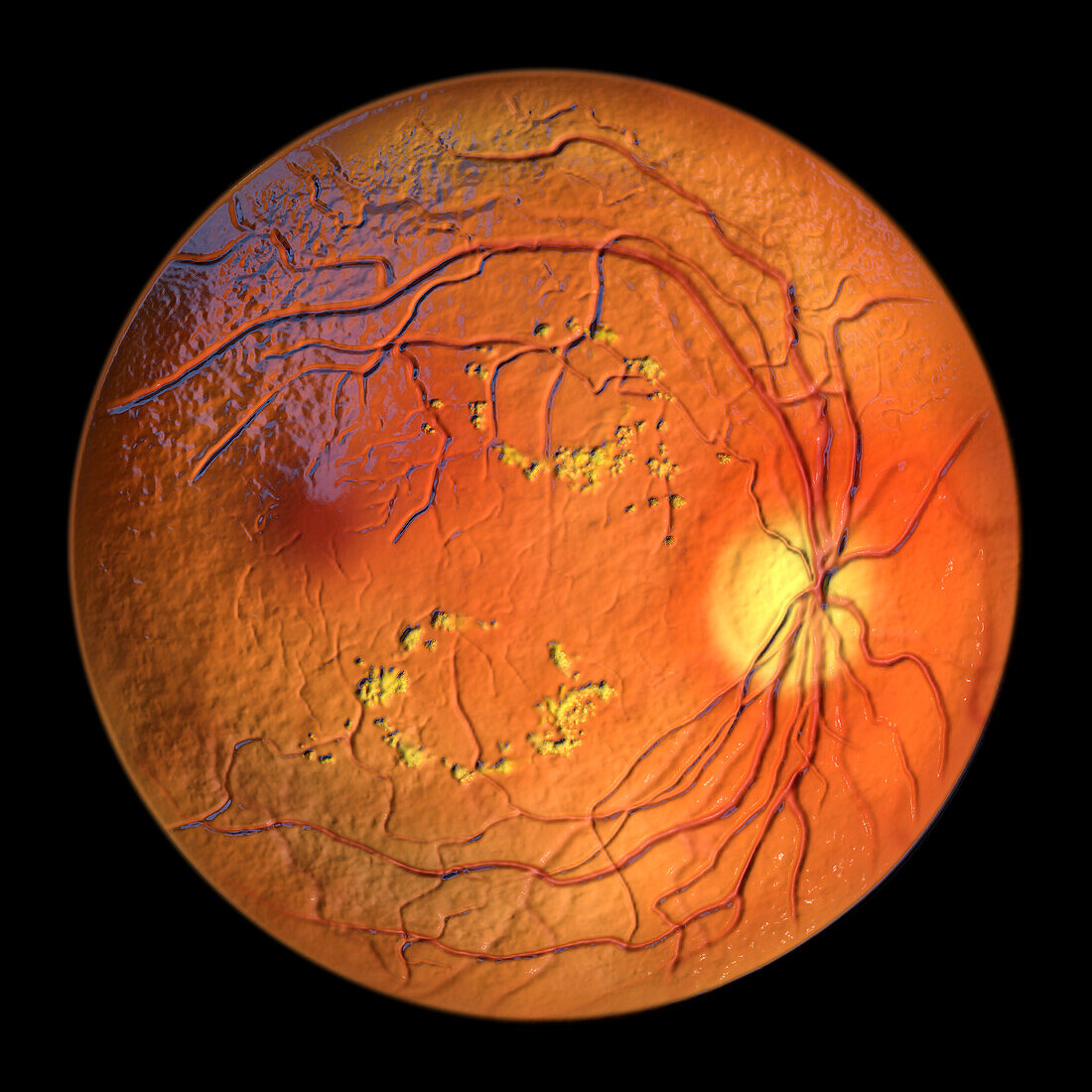 Retina damage from diabetes, illustration