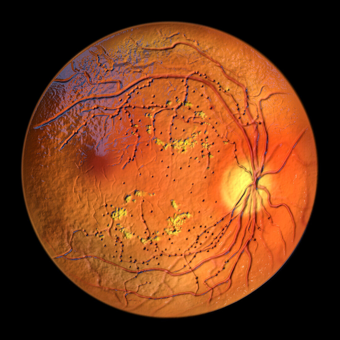 Retina damage from diabetes, illustration