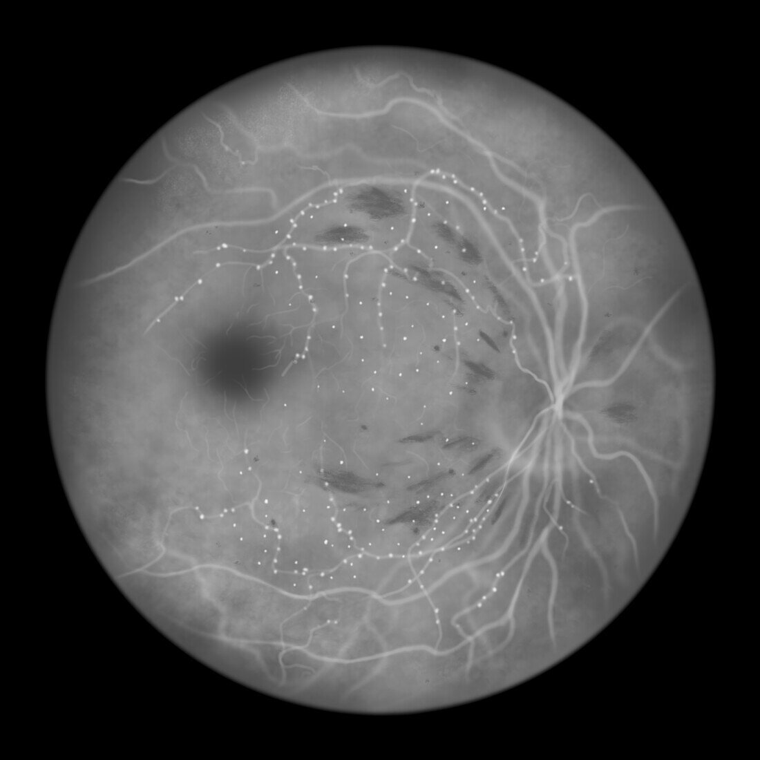 Retina damage from diabetes, illustration