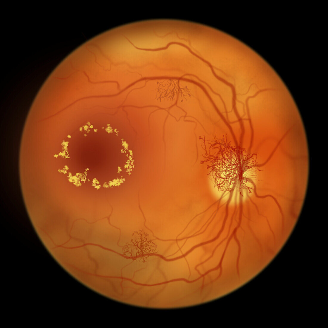 Retina damage from diabetes, illustration