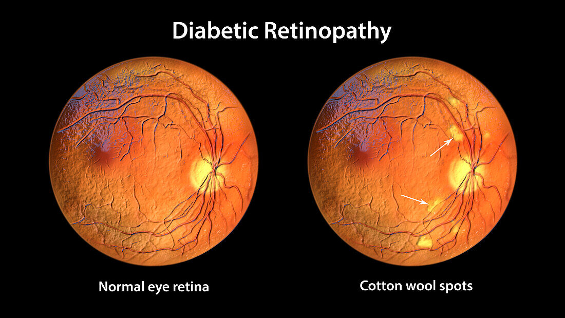 Retina damage from diabetes, illustration