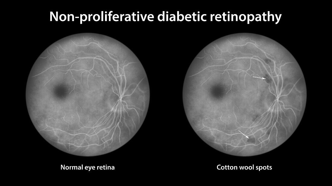 Retina damage from diabetes, illustration